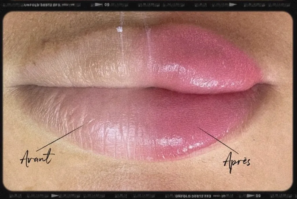 Avant et après pigmentation des lèvres, technique Candy Lips