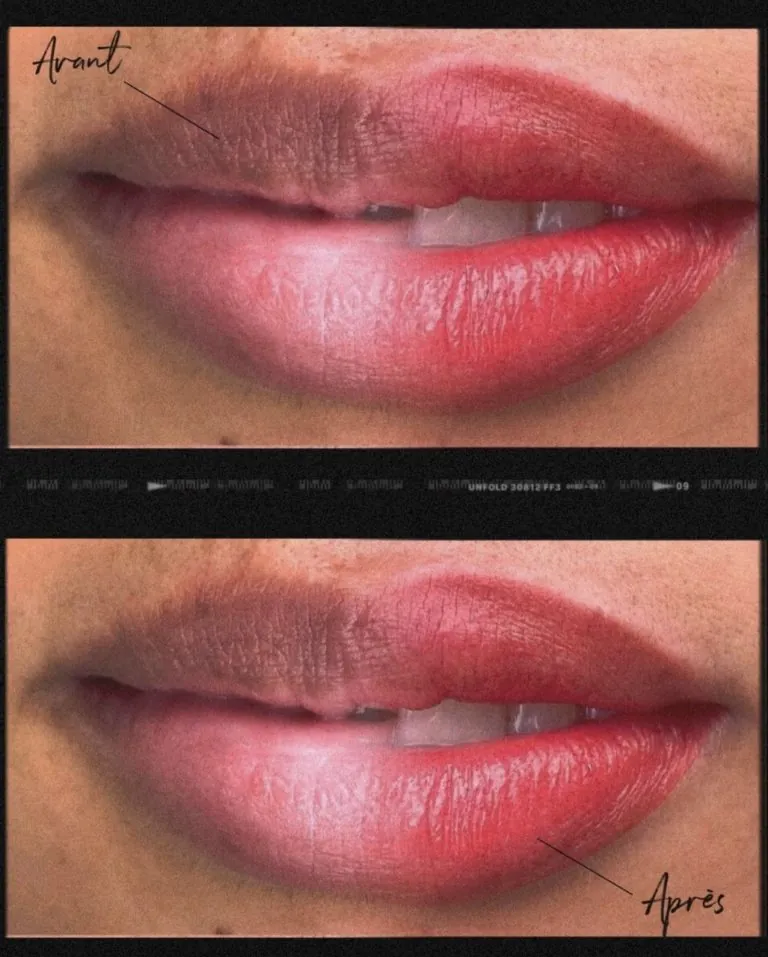 Avant et après neutralisation de lèvres foncées (Dark Lips)